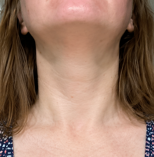 Weeks 2-3: Visible Firming Begins